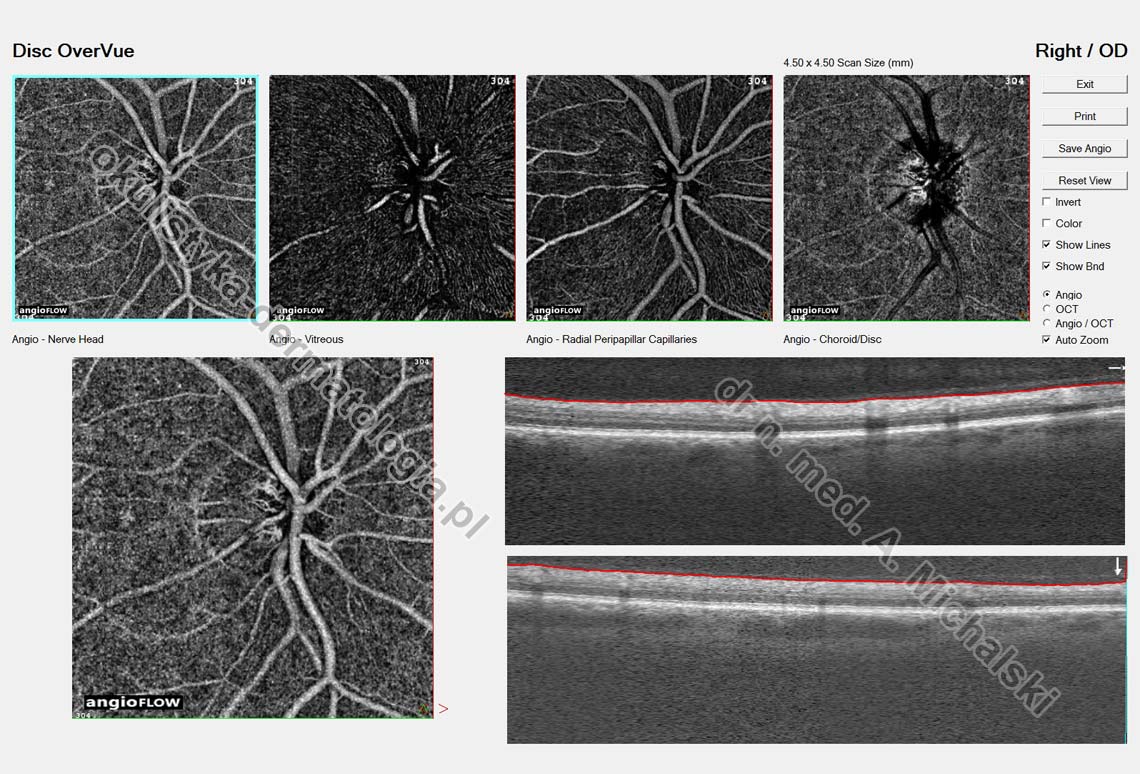 Oct Poznanpl Optyczna Koherentna Tomografia Z Angiografią Bez Kontrastu Angio Oct Oct A 2774